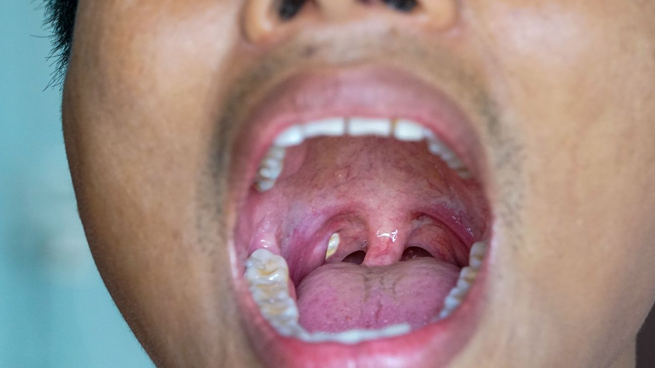 Effective Ways to Get Rid of Tonsil Stones at Home in 2025: Explore Proven Methods!